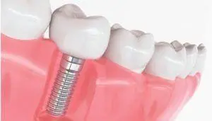 fixed dentures