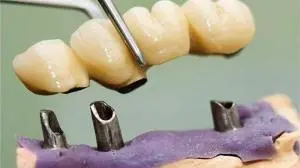 Crown and Bridge Treatment