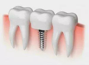 Dental Prostheses Dental Prostheses