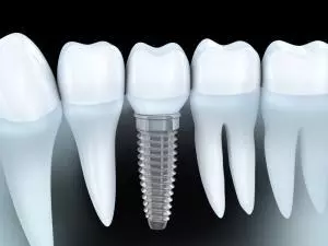 Implant Treatment