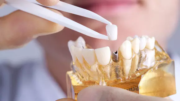 Implant Treatment