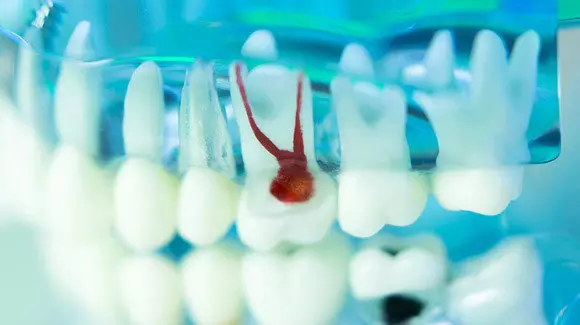 Root Canal Treatment