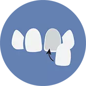 WHAT IS IMPLANT TOOTH?