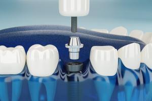 What is Implant Treatment?