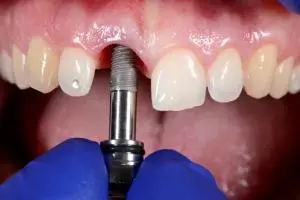 What is Implant Treatment?