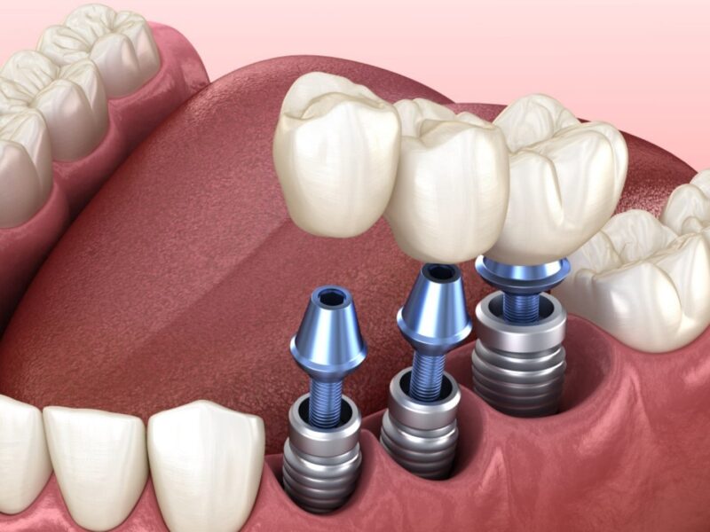 What is Implant Treatment?