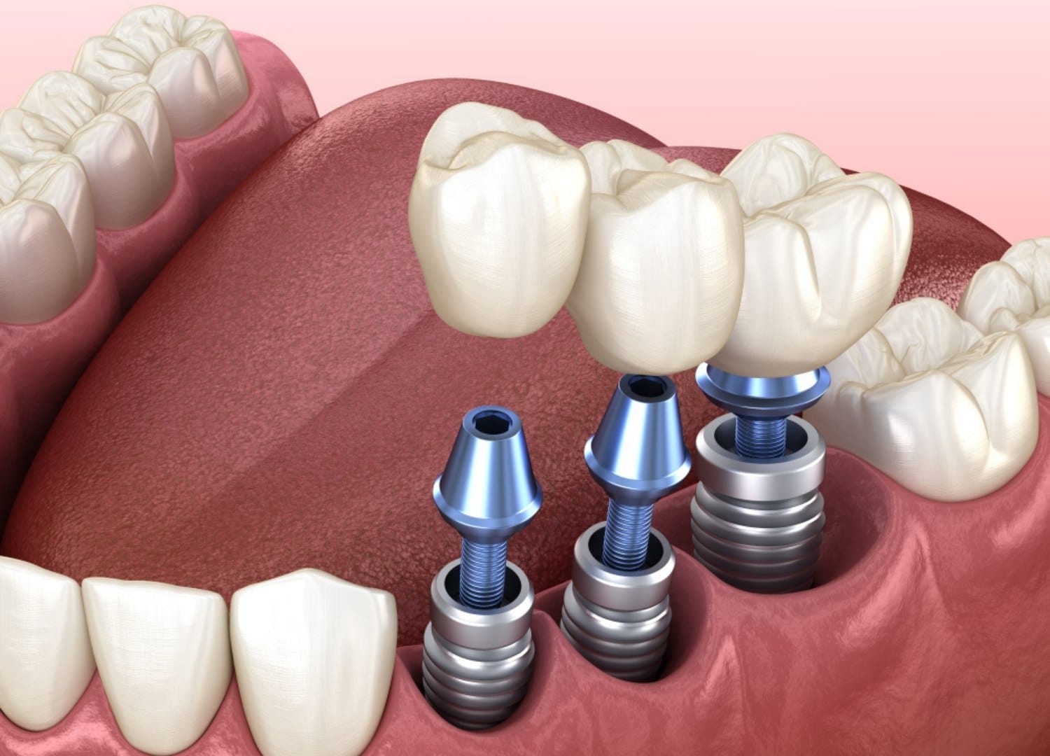 What is Implant Treatment?