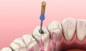 How To Do Root Canal Treatment