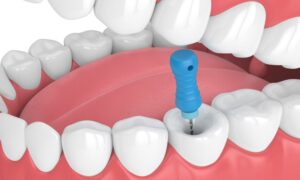 Root Canal Treatment Prices