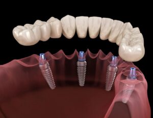 What is Implant Treatment? How Is It Done? 