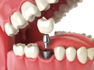 What is Implant Treatment? How Is It Done? 