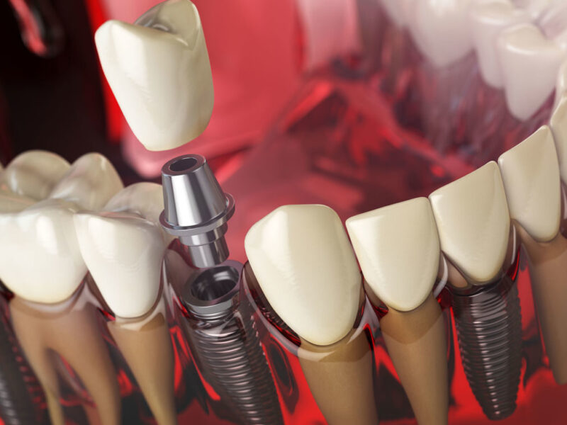 What is Implant Treatment? How Is It Done?