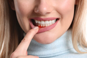 What is Gum Inflammation?