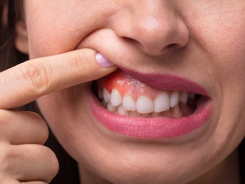 What is Gum Inflammation?