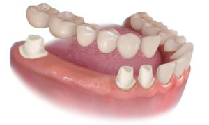 Dental Prostheses Application Process