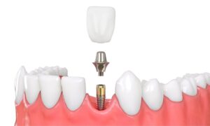 What Is A Dental Implant