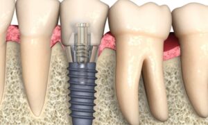 What Is A Dental Implant