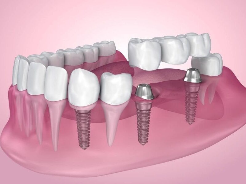 What Is A Dental Implant