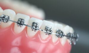 Braces Treatment