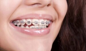 Braces Treatment