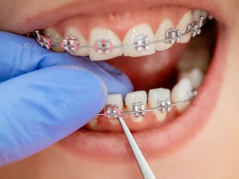 Braces Treatment