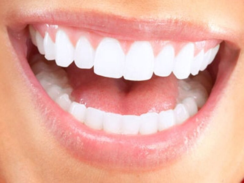 Teeth Whitening