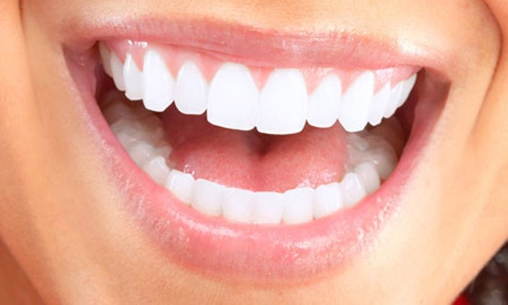 Teeth Whitening