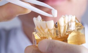 Crown Bridge Treatment