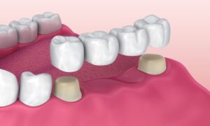 Crown Bridge Treatment