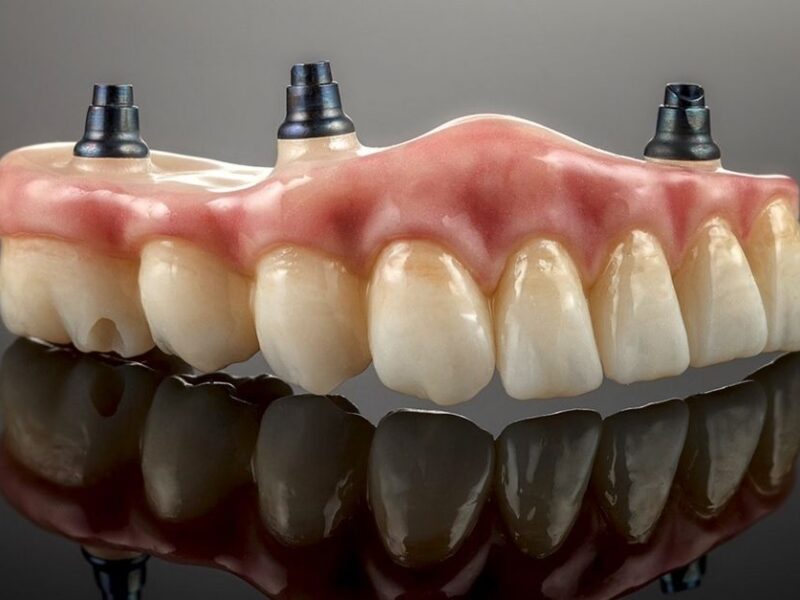 Crown Bridge Treatment