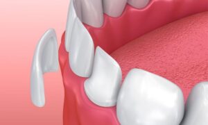 Laminates Dental