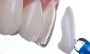 Laminates Dental