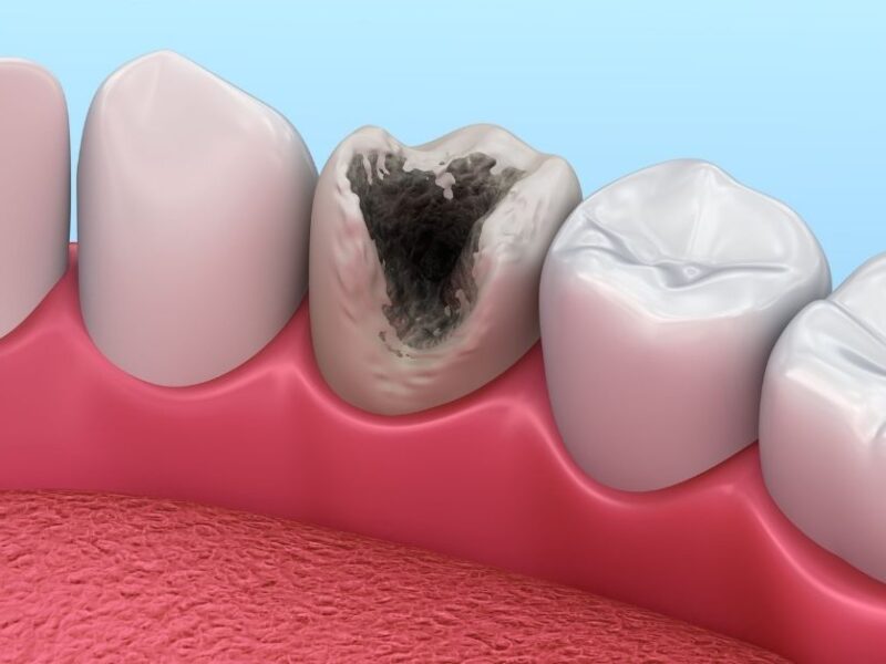 Tooth Decay Treatment